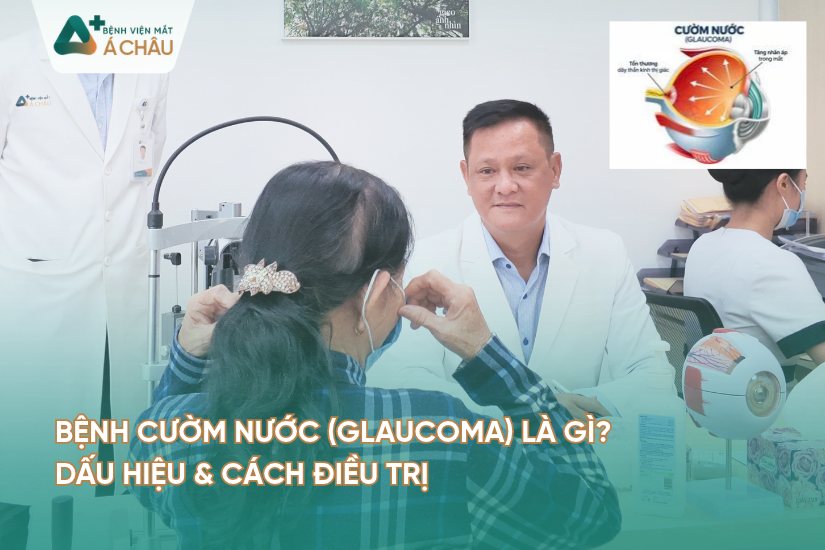 Bệnh Cườm Nước (Glaucoma) Là Gì? Dấu Hiệu & Cách Điều Trị