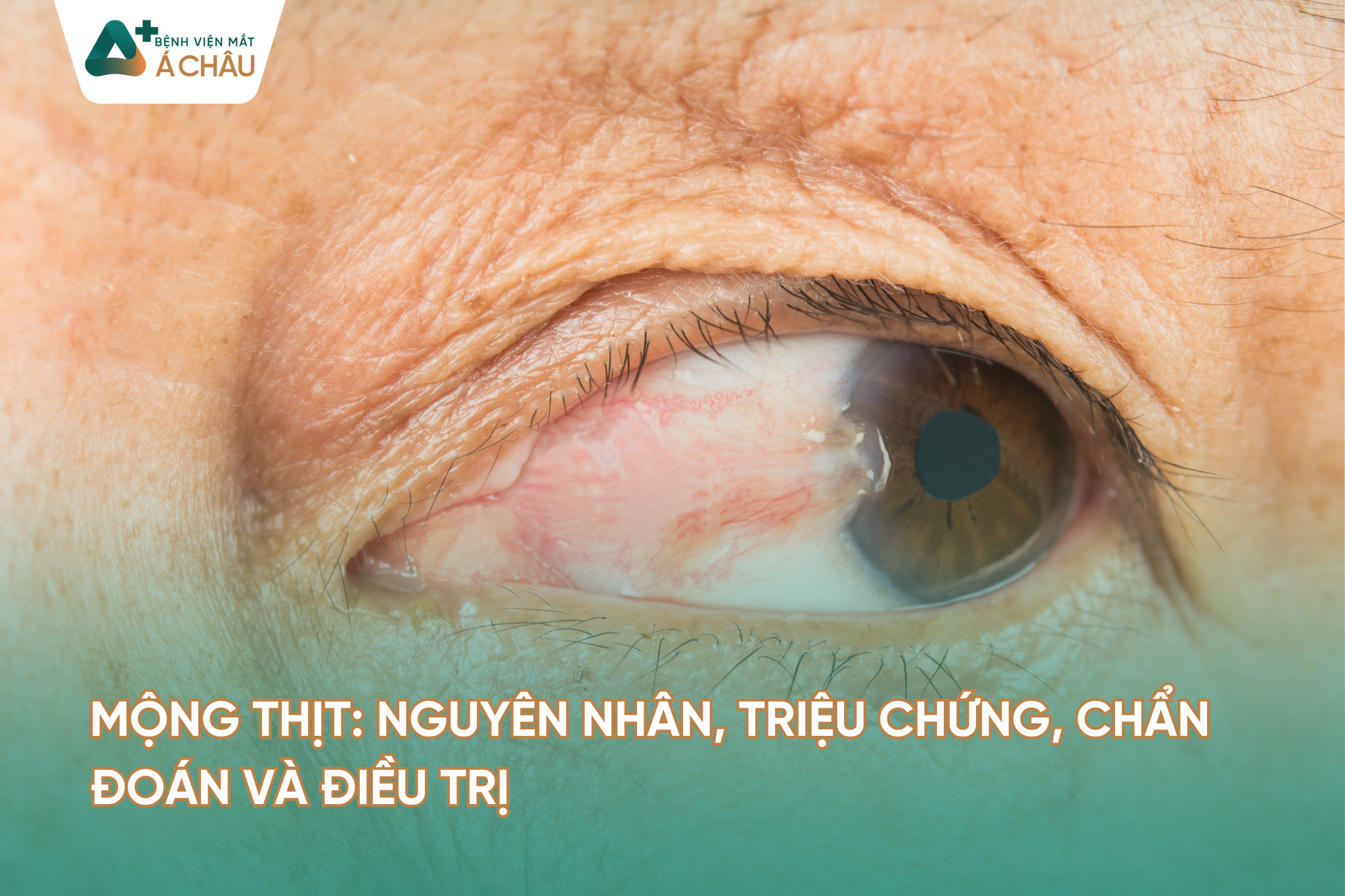 Mộng Thịt: Nguyên Nhân, Triệu Chứng, Chẩn Đoán Và Điều Trị