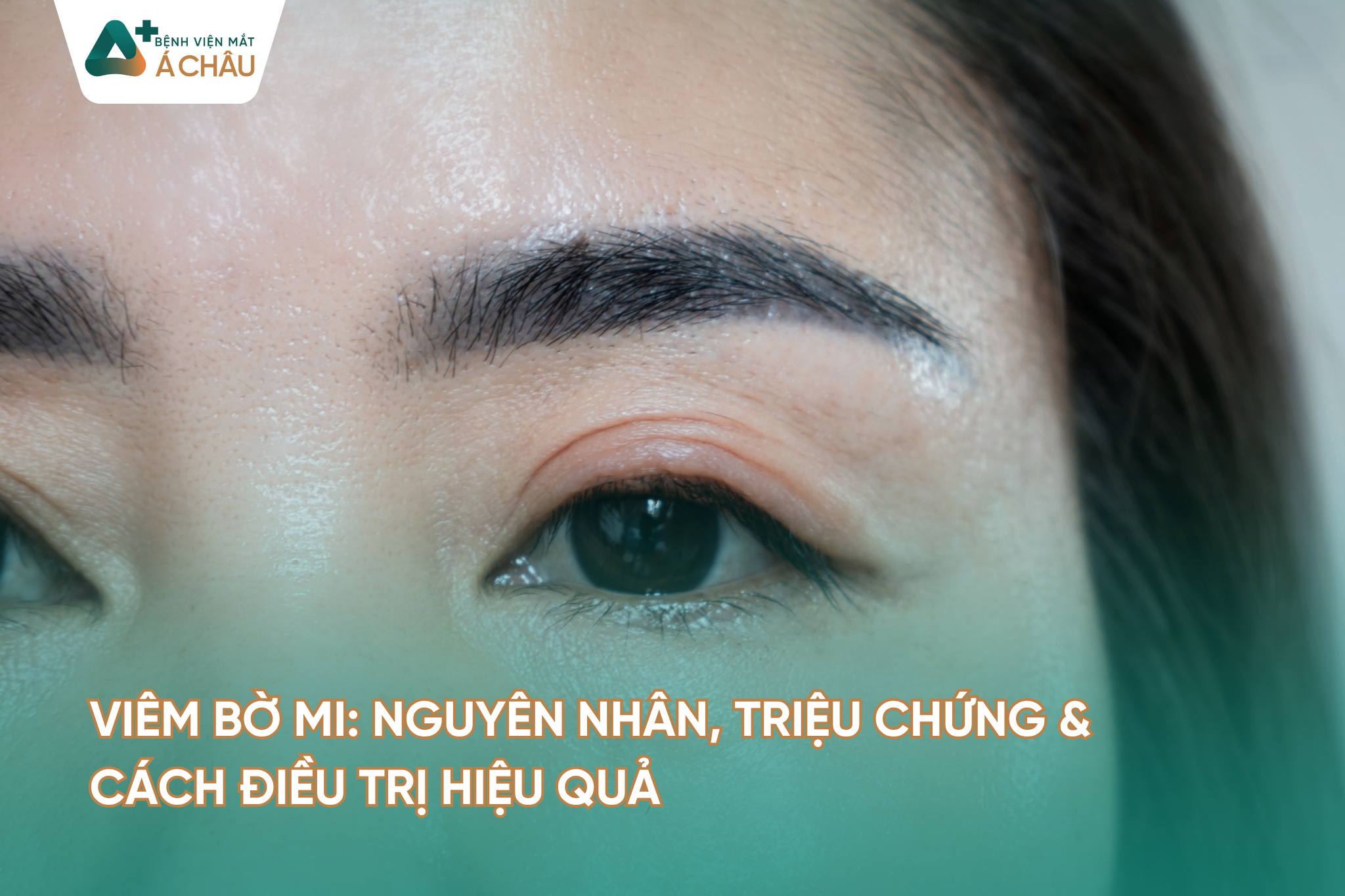 Viêm Bờ Mi: Nguyên Nhân, Triệu Chứng & Cách Điều Trị Hiệu Quả