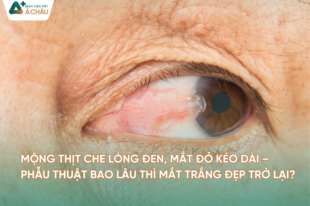 MỘNG THỊT CHE LÒNG ĐEN, MẮT ĐỎ KÉO DÀI – PHẪU THUẬT BAO LÂU THÌ MẮT TRẮNG ĐẸP TRỞ LẠI?
