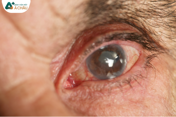 glaucoma (576 KB)
