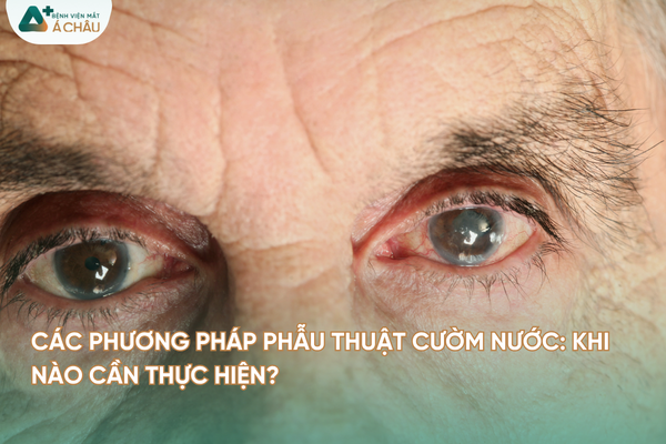 Các phương pháp phẫu thuật cườm nước: Khi nào cần thực hiện?