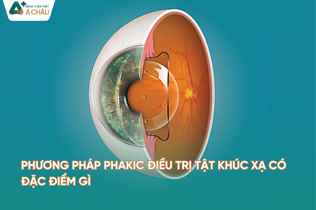 Phương pháp PHAKIC Điều trị tật khúc xạ có đặc điểm gì