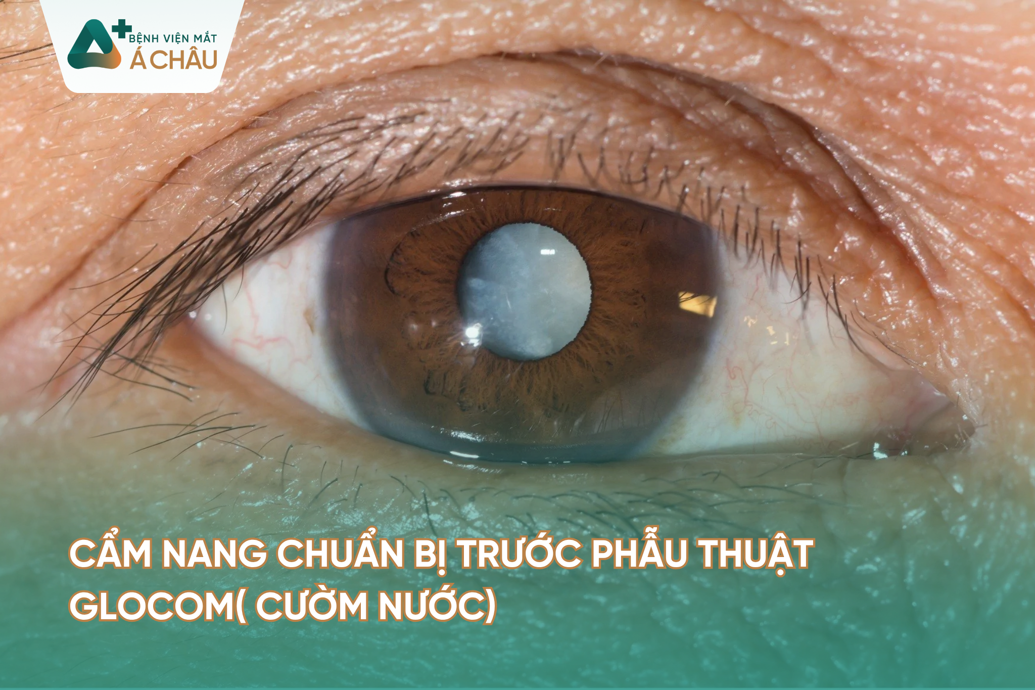 Cườm nước